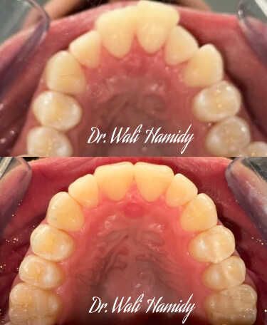 Invisalign Before & Afters