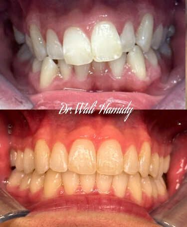 Invisalign Before & Afters