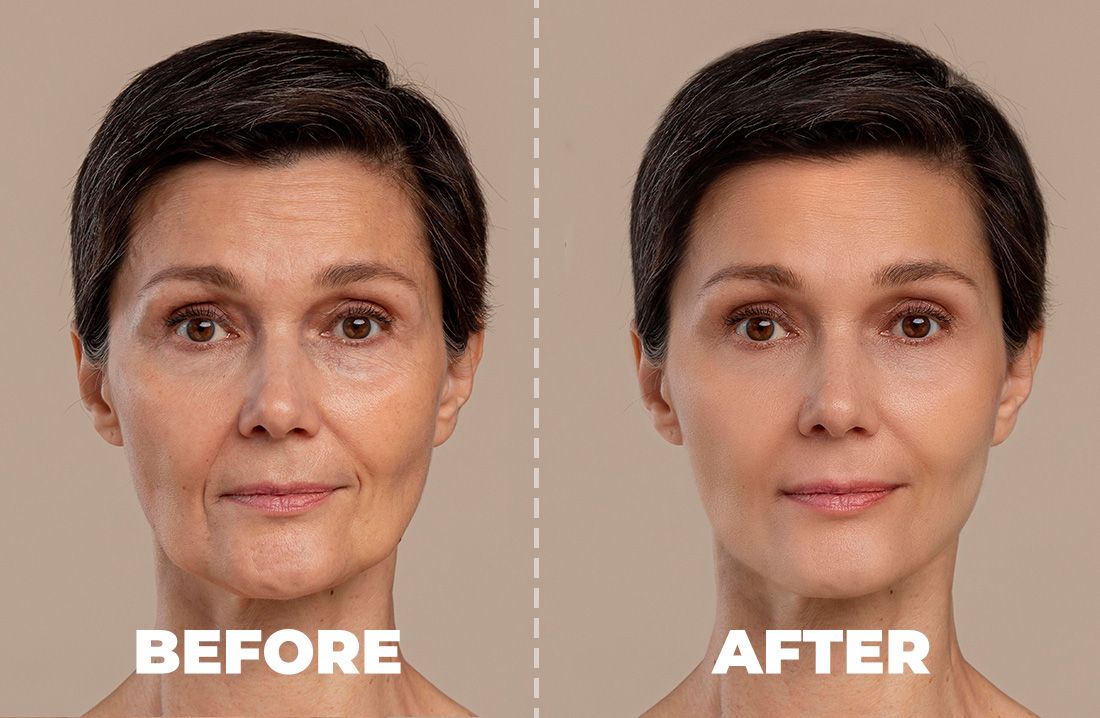 Radiesse A More Youthful Look