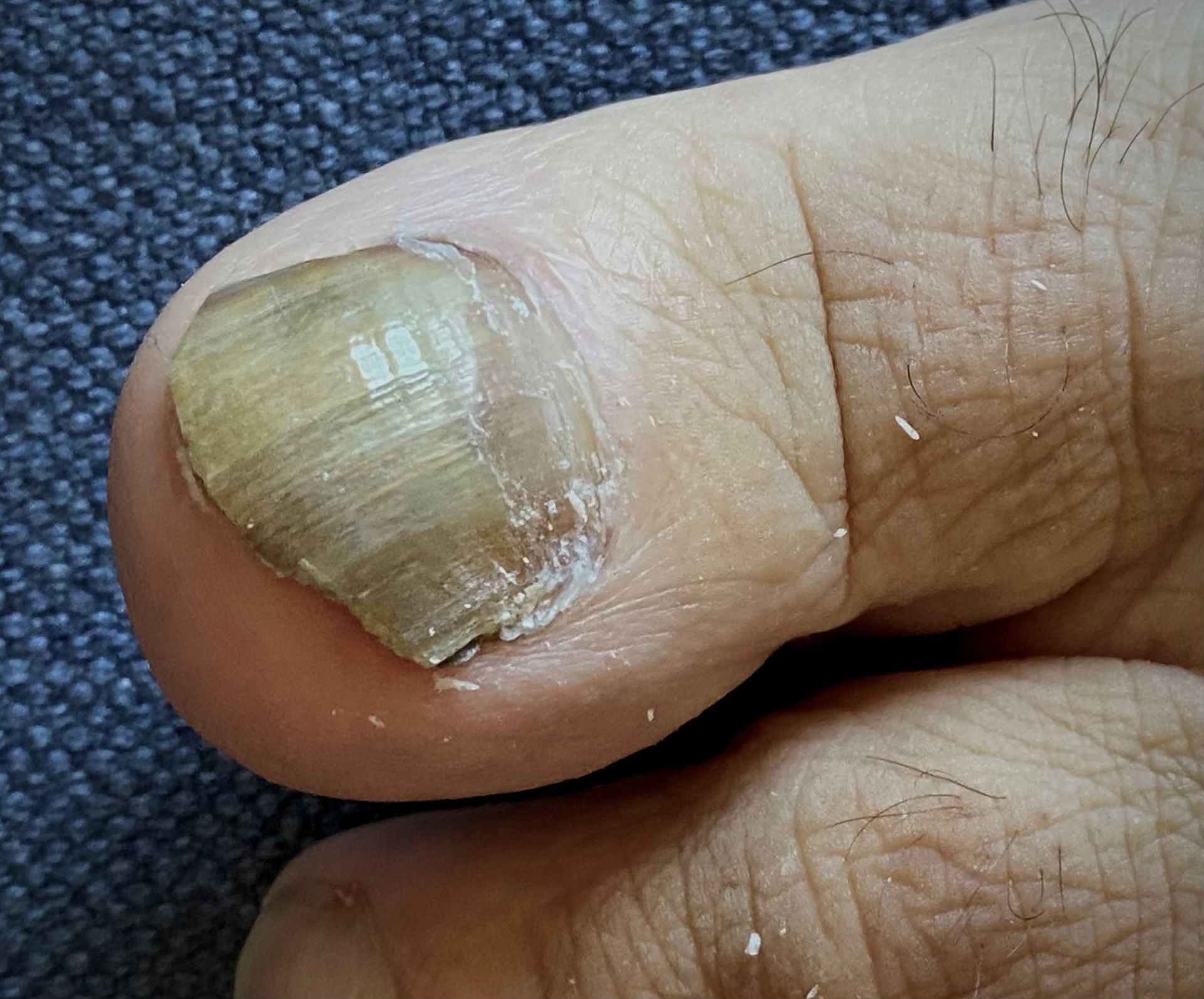 Toenail Fungus — King County, WA — Ankle And Foot Specialists Of Puget Sound