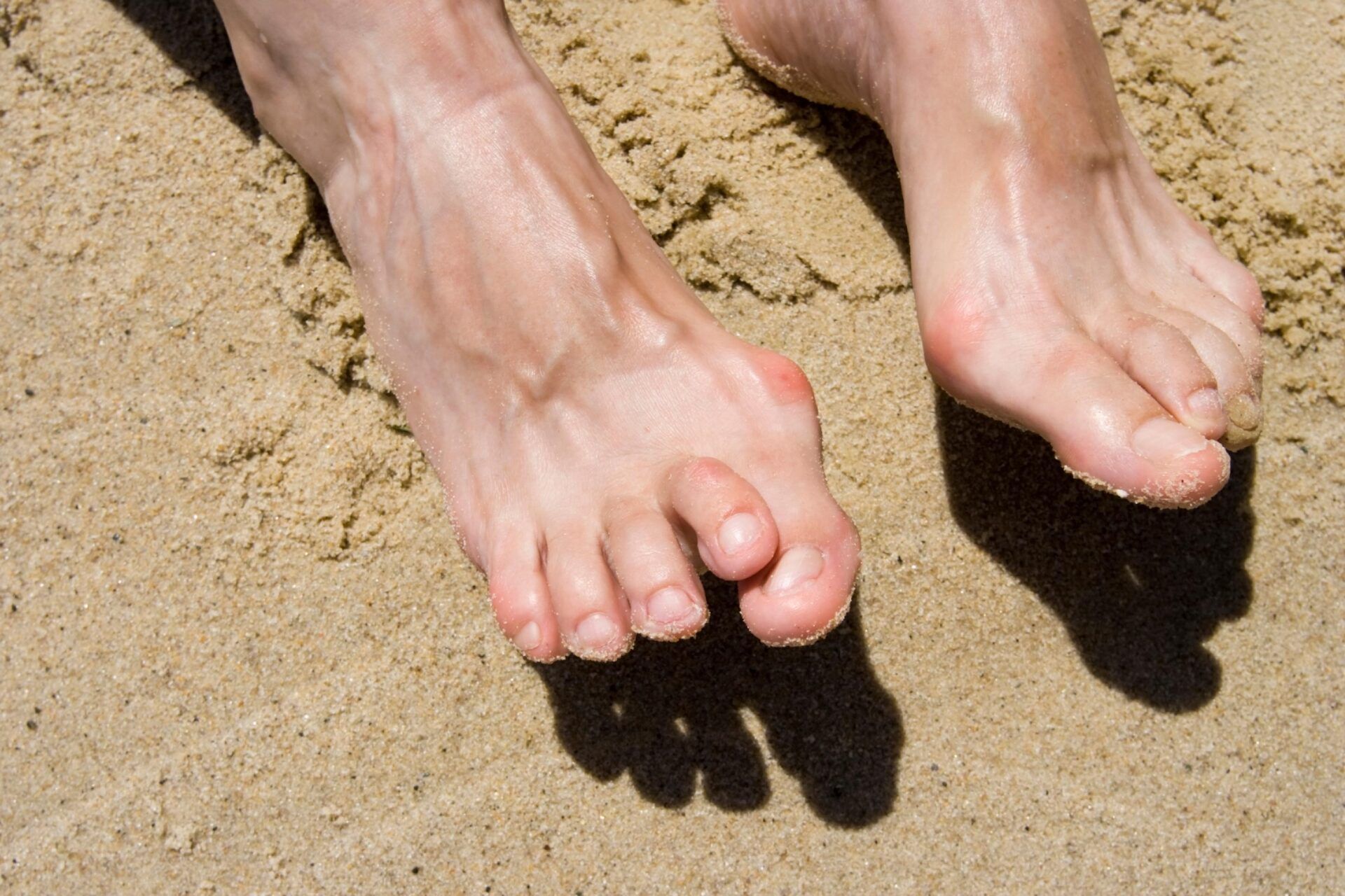Hammertoe Feet — King County, WA — Ankle And Foot Specialists Of Puget Sound