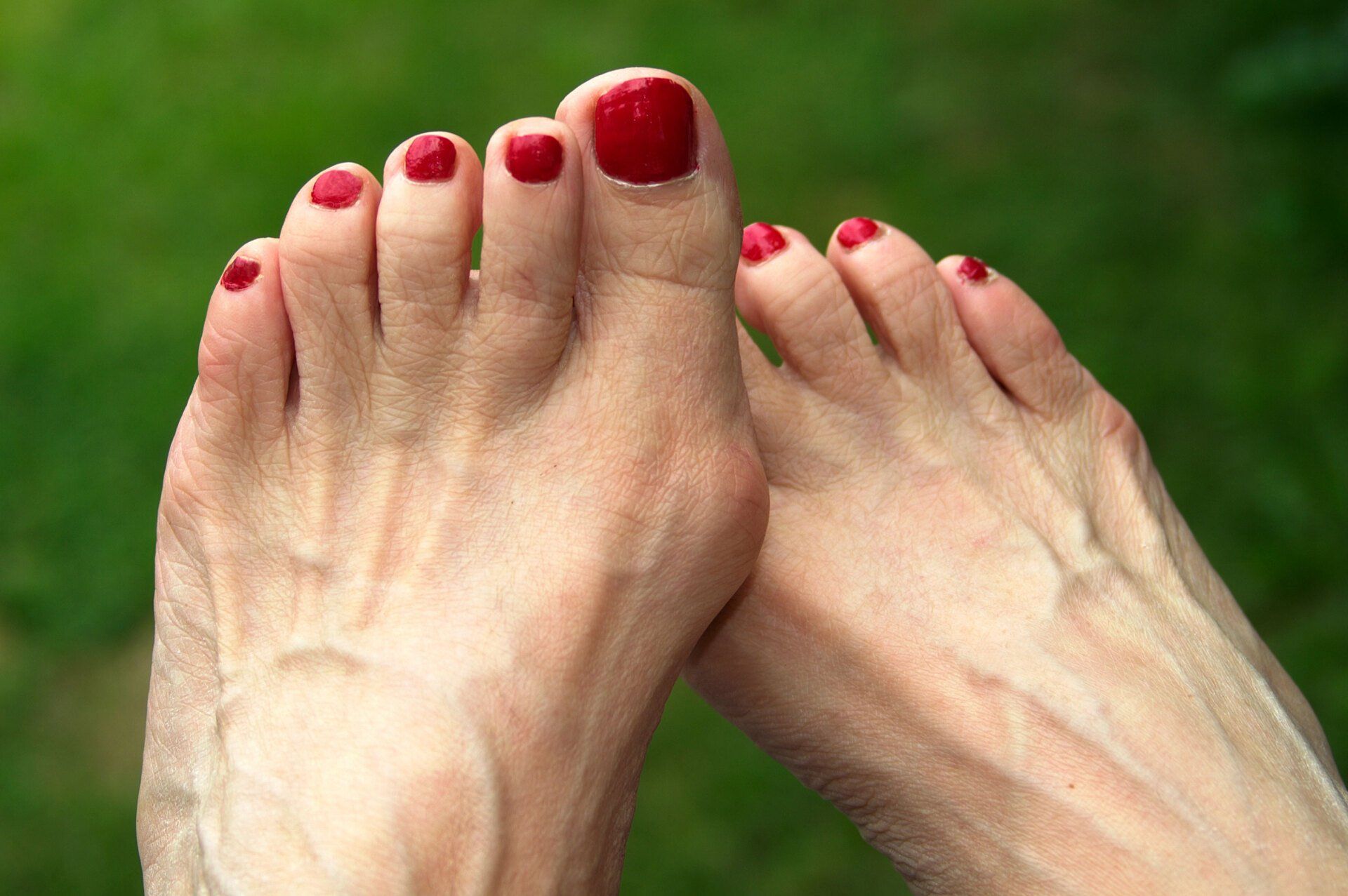 Woman's Bunion Feet — King County, WA — Ankle And Foot Specialists Of Puget Sound