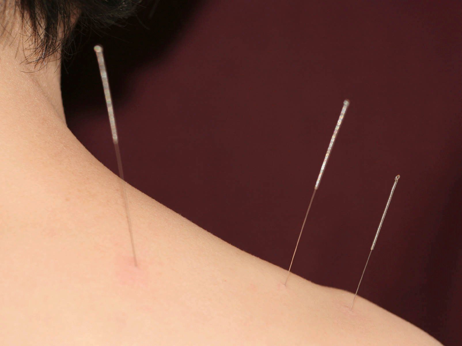 acupuncture needles in skin