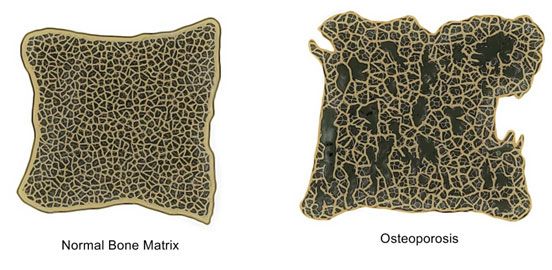 Normal bone matrix and a picture of osteoporosis - Springfield Central, QLD - Orion Family Physiotherapy