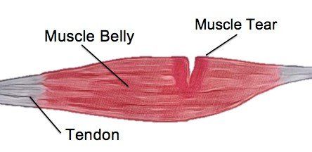 muscle tear graphic