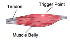 Muscular Trigger Points Illustration