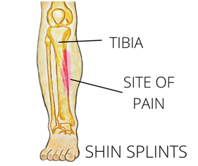 A diagram of a shin splint showing the location of pain