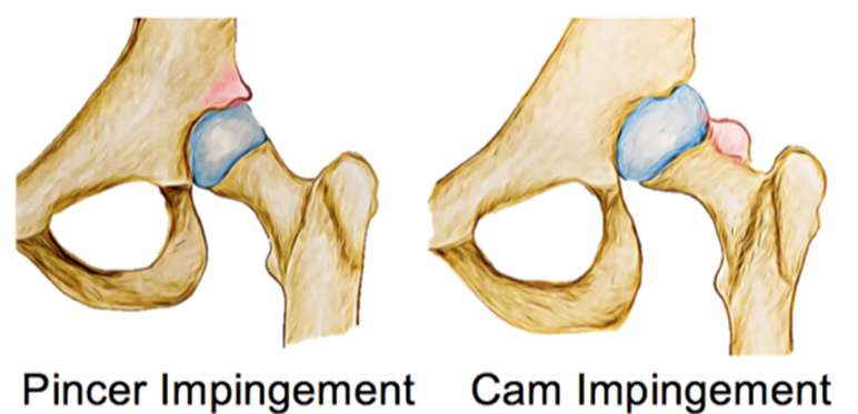 Pincer And Cam Impingement - Springfield Central, QLD - Orion Family Physiotherapy