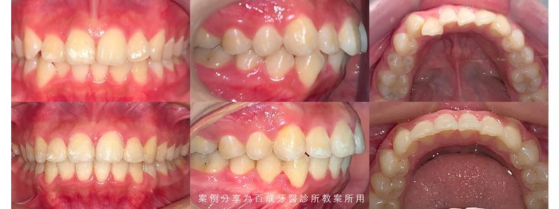 矯正案例分享