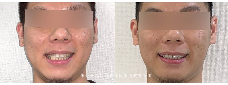 矯正案例分享