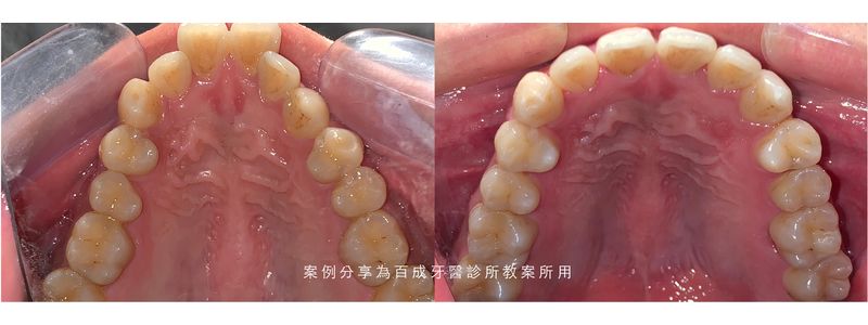 A before and after picture of a person 's teeth.