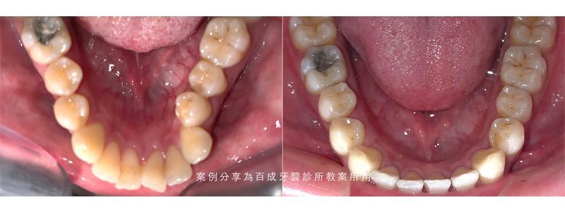 A before and after picture of a person 's teeth.