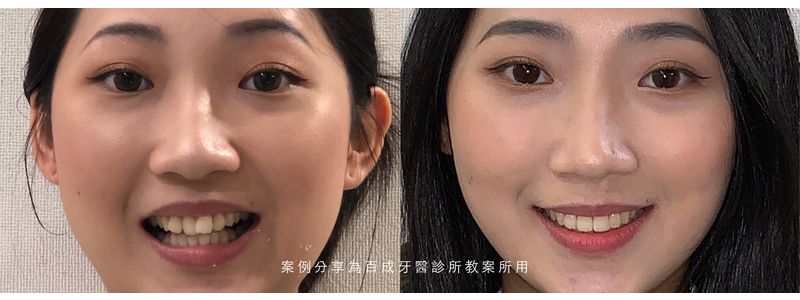 矯正案例分享