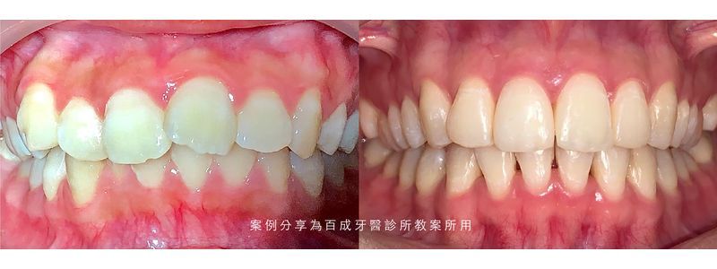 矯正案例分享