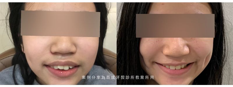 矯正案例分享