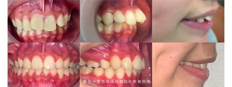 矯正案例分享