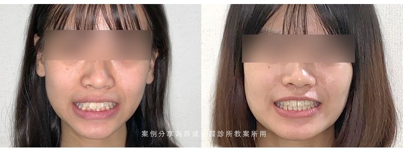 矯正案例分享