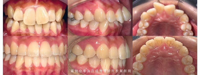 矯正案例分享
