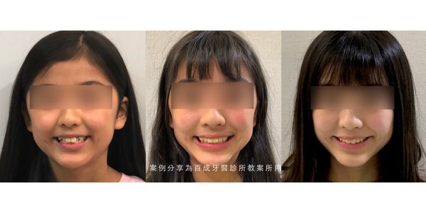 矯正案例分享