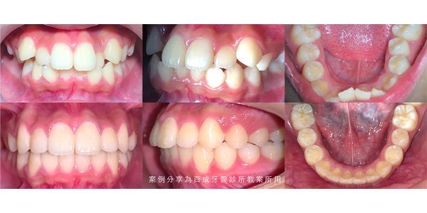 矯正案例分享