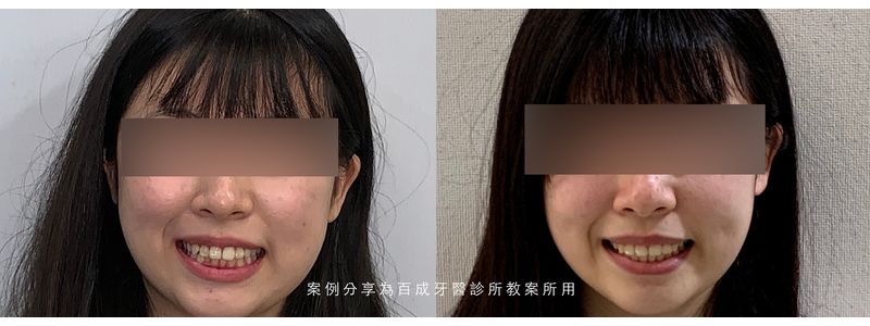 矯正案例分享