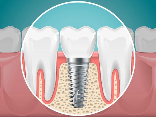 illustrazione di implantologi dentale