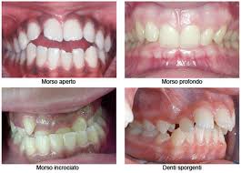 ortodonzia allineamento denti