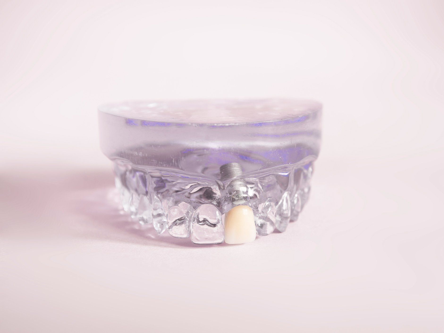 Transparent model for dental implants | Ringwood, VIC | Abstract Arch Denture Clinic