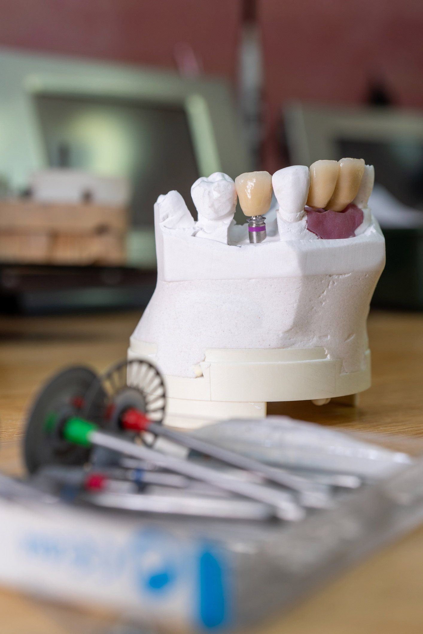 Dental implant model | Ringwood, VIC | Abstract Arch Denture Clinic