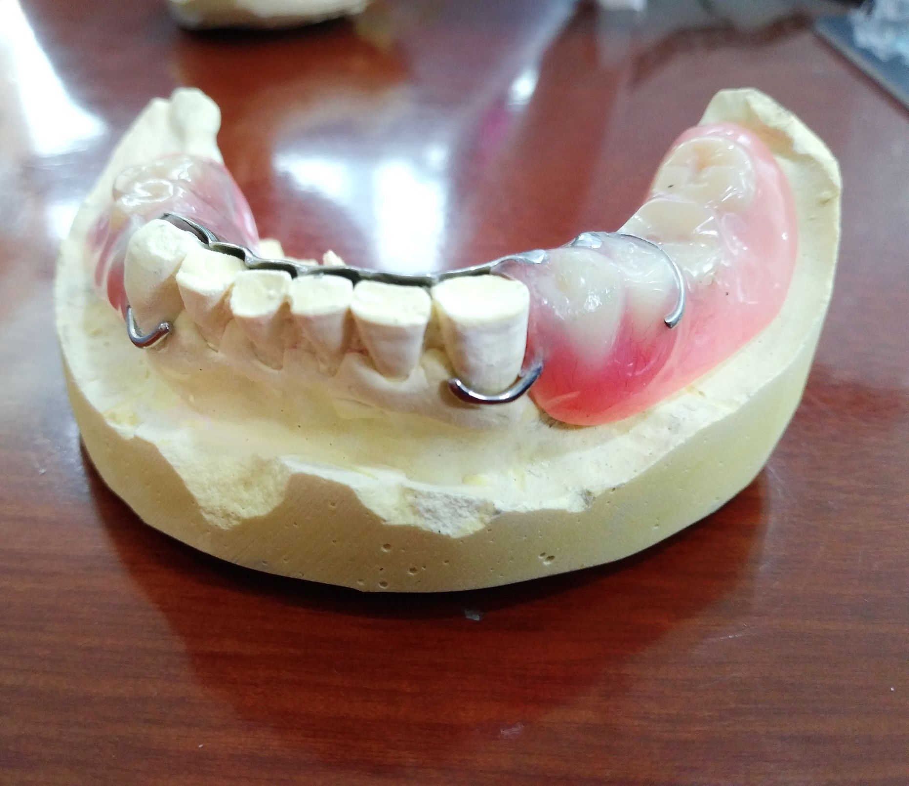 A mandibular partial denture.