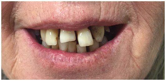 Before senior teeth | Ringwood, VIC | Abstract Arch Denture Clinic