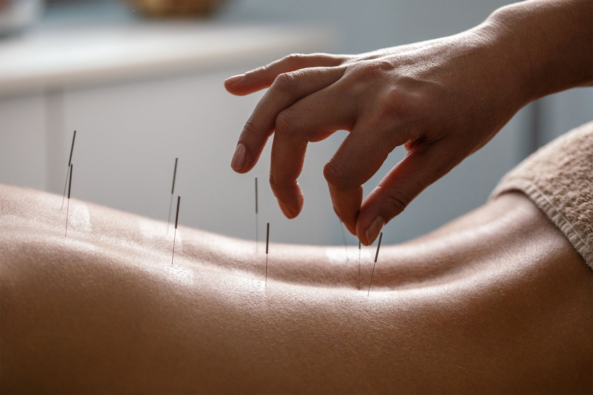 Patient lying face down with a hand placing filiform needles in lower back