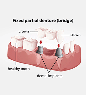 Fixed Partial Denture - Dental Services in Omaha, NE