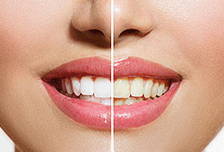 Teeth Before and After Whitening - Dentist in Omaha, NE