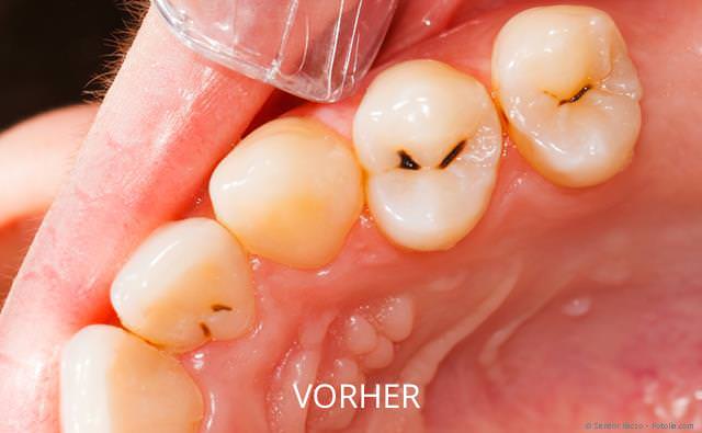 ästhetische Zahnfüllung aus Kunststoff München