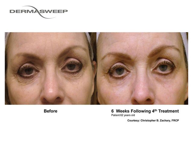 Fine Lines  DermaSweep