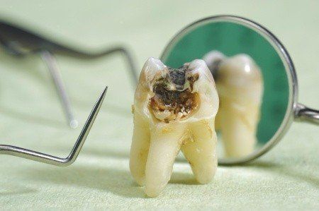 tooth decay, oral care, fluoride treatments
