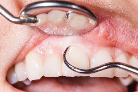 gum disease, dental care