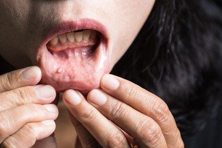 mucositis, oral health, dental health