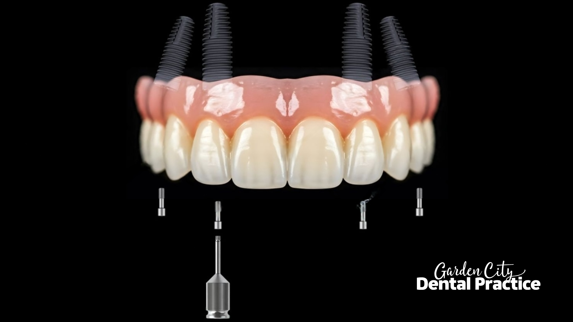 3D illustration of an upper All-on-4 dental implant prosthesis with four titanium implants and abutments shown in place, representing full-arch teeth replacement by Garden City Dental Practice in Toowoomba.