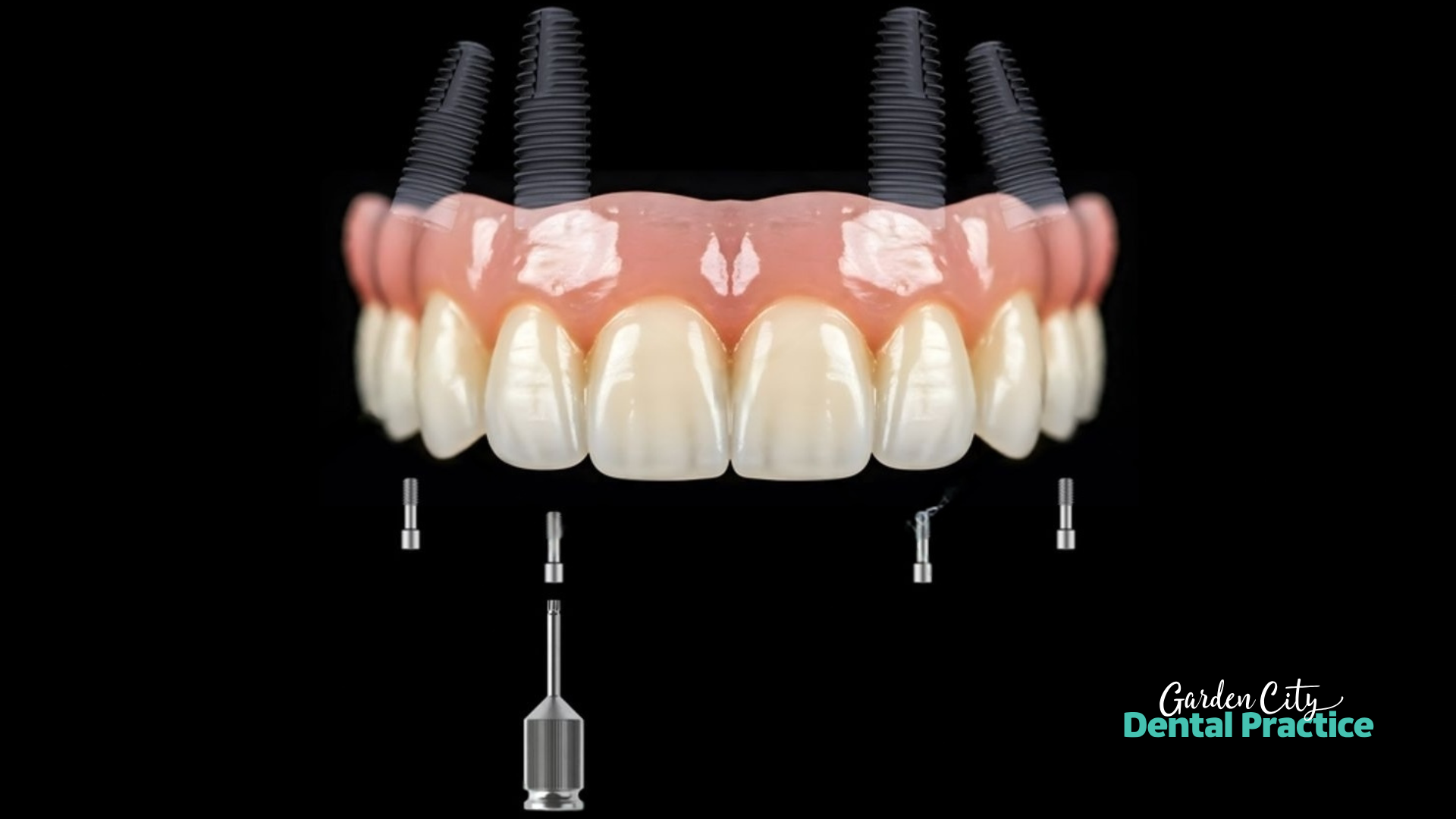 Digital diagram of the All-on-4 dental implant system showing four angled implants supporting a full upper arch prosthesis at Garden City Dental Practice.