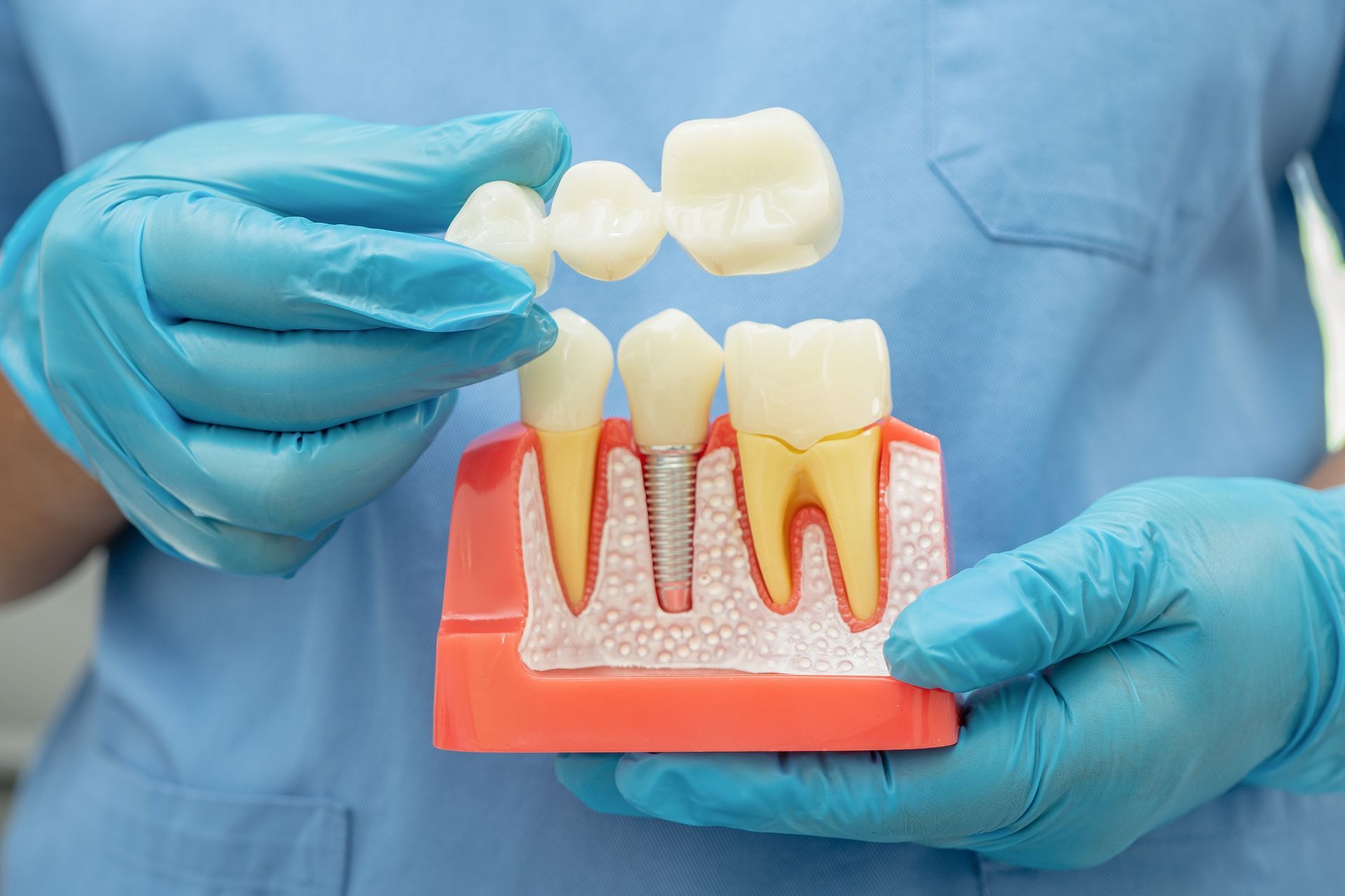 Close-up dental model showing bridge and implant-supported tooth replacement