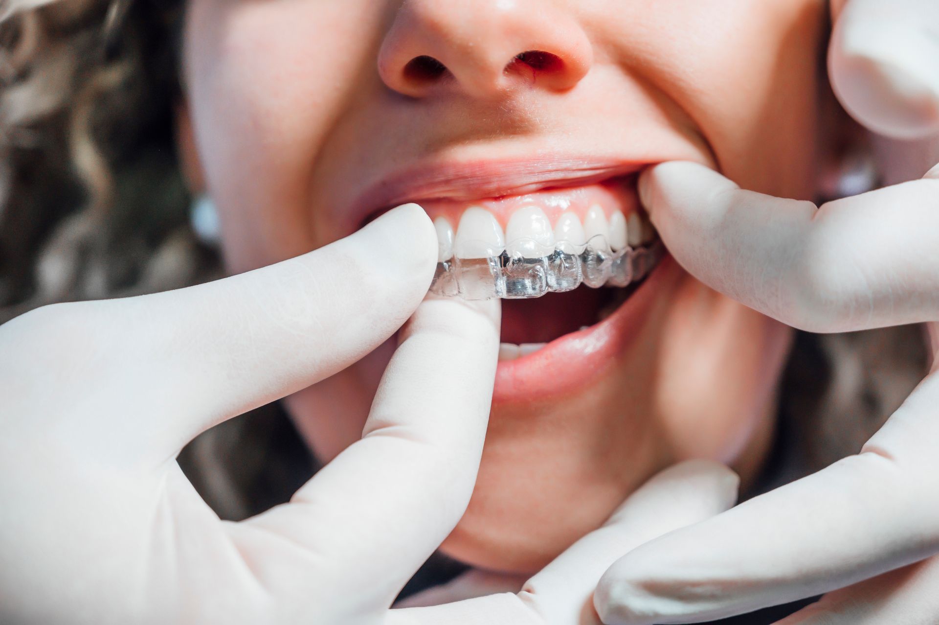 doctor putting a clear dental aligner to the patient's teeth