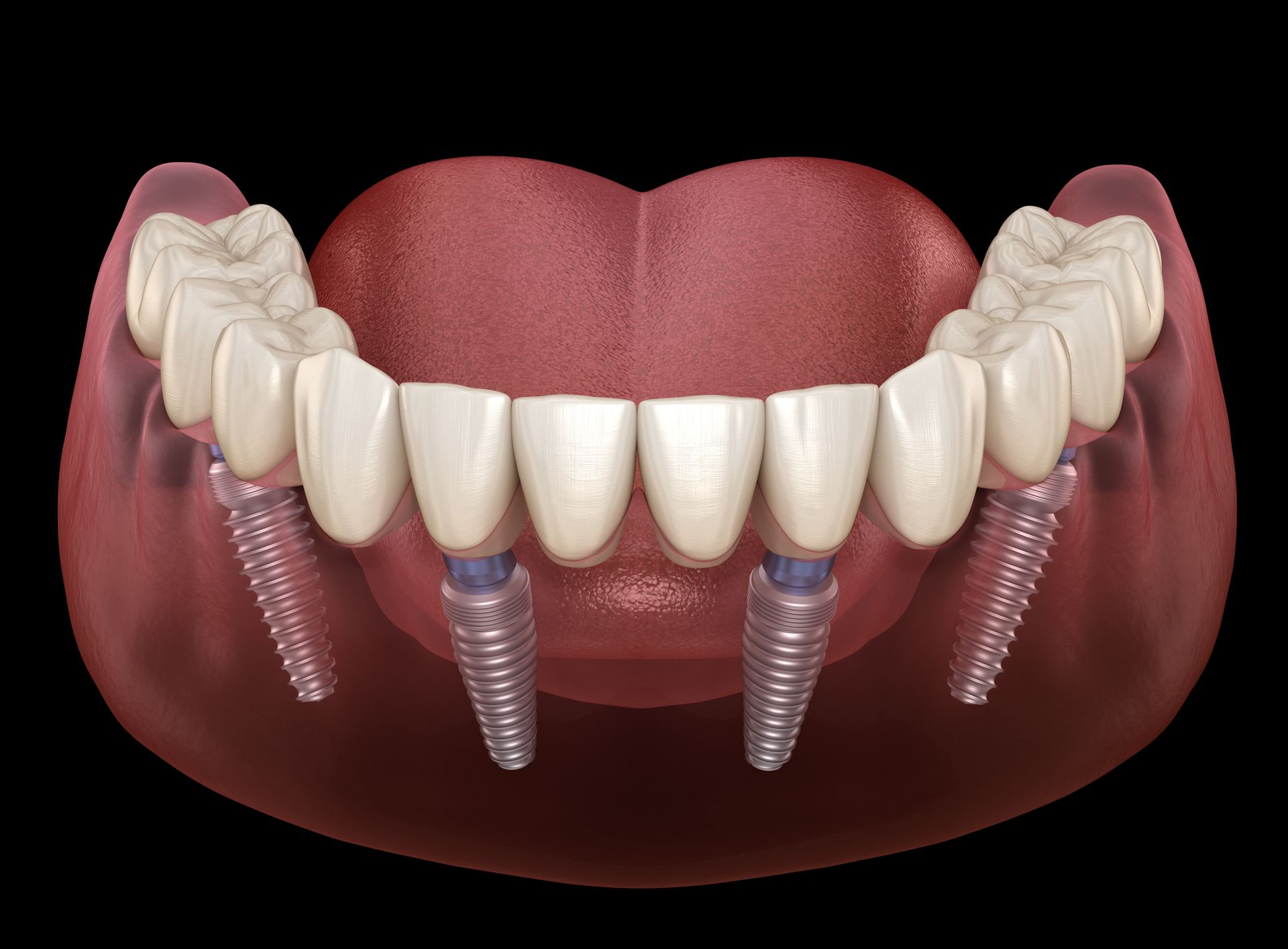 Illustration showing All-on-4 dental implants supporting a full arch of replacement teeth.