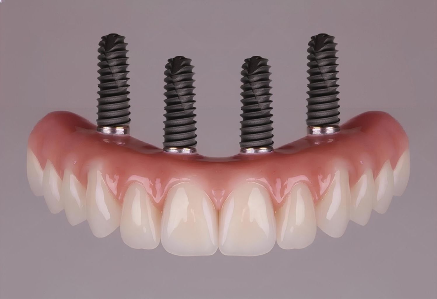 Close-up of All-on-4 dental implant model showing full upper arch prosthetic teeth secured by four titanium implants, ideal for full-mouth restoration in Toowoomba.