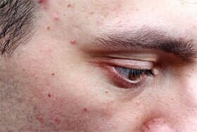 Man needing acne treatment - Skin Care in Des Moines, IA Man needing acne treatment - Skin Care in Des Moines, IA