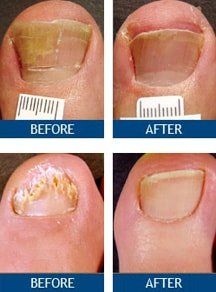 Toe nail fungus treatment before and after photos. Showing yellow, brittle nails improving.
