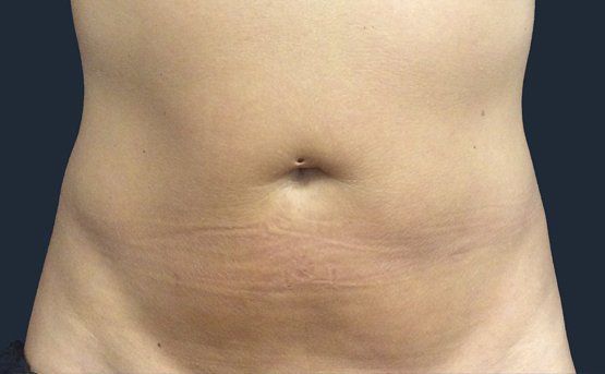 A light-skinned person's abdomen, showing stretch marks, with a dark background.
