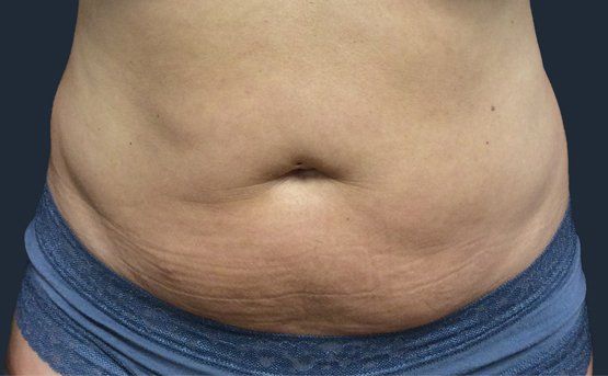 Close-up of a person's abdomen showing skin folds, stretch marks, and navel.