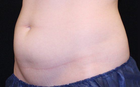 Abdomen, side view, after procedure, showing surgical incision. Skin tone is fair, blue garment bottom.